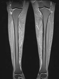 MRI image of the legs