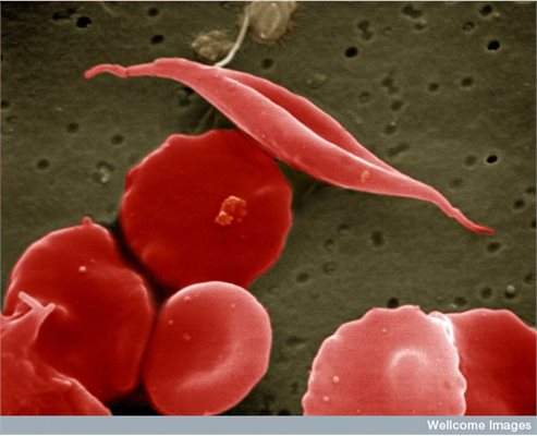 Sickle and other red blood cells