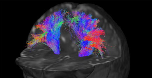 A colourful brain scan belonging to a child