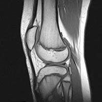 MRI image of the knee