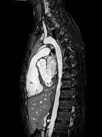 MRI image of the heart