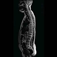 MRI image of the spine